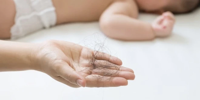 Rụng tóc sau sinh